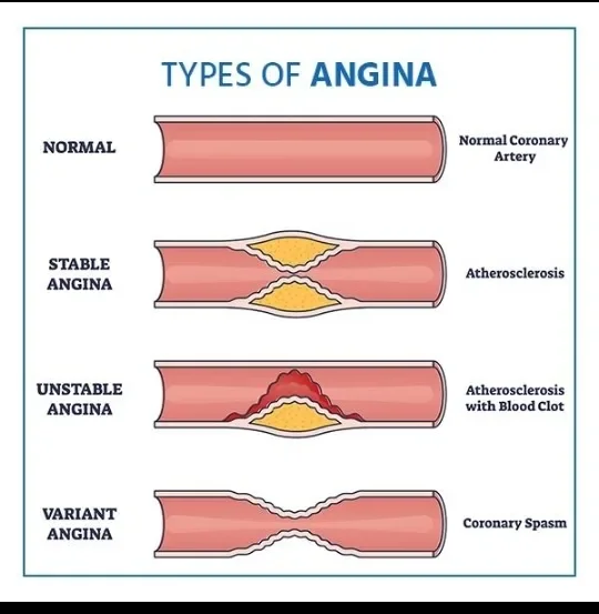 image about Coronary Artery Disease: How It Develops and Its Symptoms