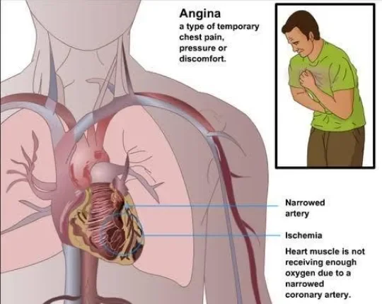 image about Coronary Artery Disease: How It Develops and Its Symptoms
