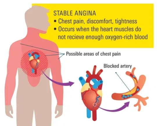 image about Coronary Artery Disease: How It Develops and Its Symptoms