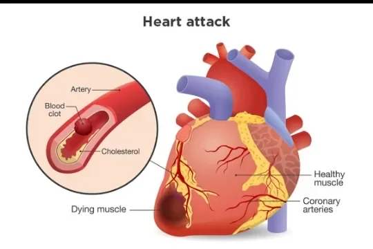 image about Coronary Artery Disease: How It Develops and Its Symptoms