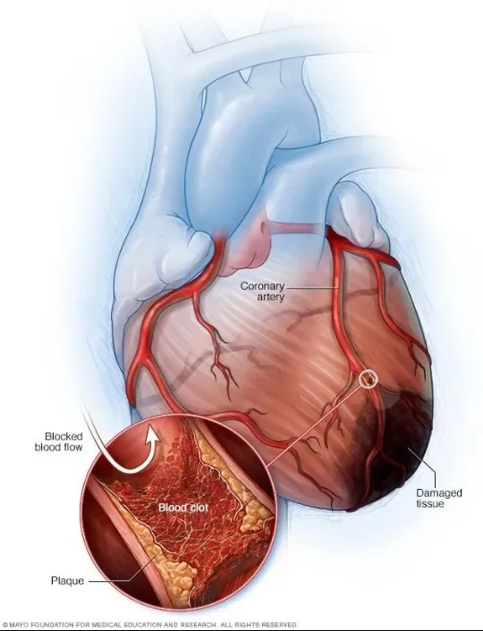 image about Coronary Artery Disease: How It Develops and Its Symptoms