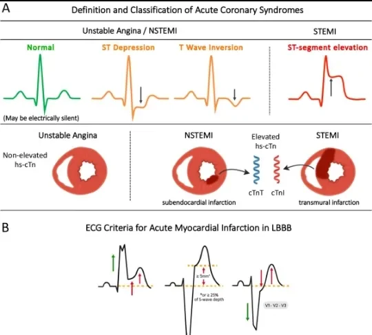 image about Coronary Artery Disease: How It Develops and Its Symptoms