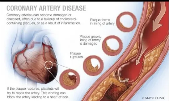 image about Heart Attack: Symptoms, Causes, and When It Becomes an Emergency