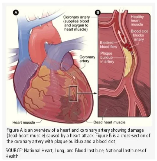 image about Heart Attack: Symptoms, Causes, and When It Becomes an Emergency