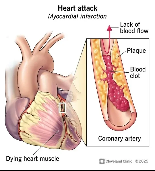 image about Heart Attack: Symptoms, Causes, and When It Becomes an Emergency