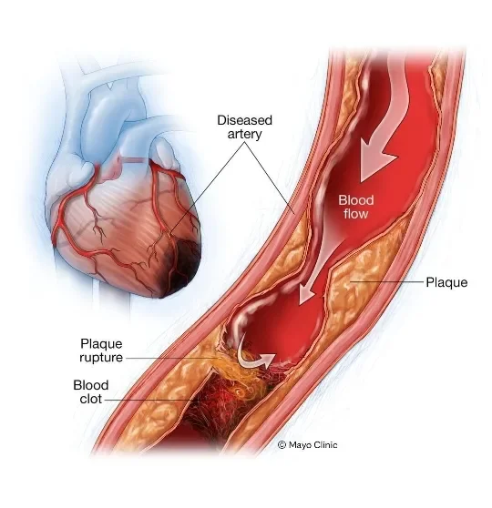 image about Heart Attack: Symptoms, Causes, and When It Becomes an Emergency