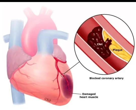 image about Heart Attack: Symptoms, Causes, and When It Becomes an Emergency