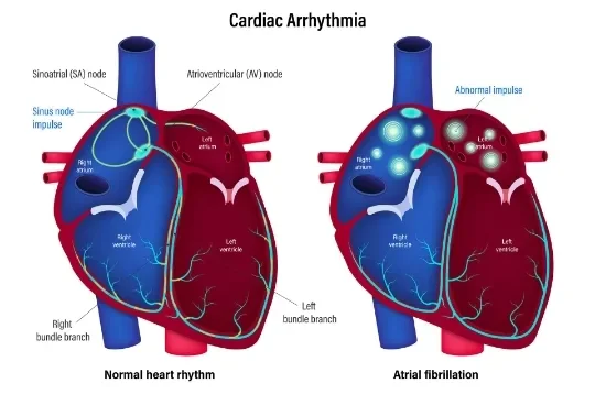 image about Cardiac Arrhythmia: Types, Symptoms, and Diagnostic Methods