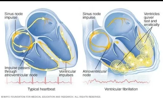 image about Cardiac Arrhythmia: Types, Symptoms, and Diagnostic Methods
