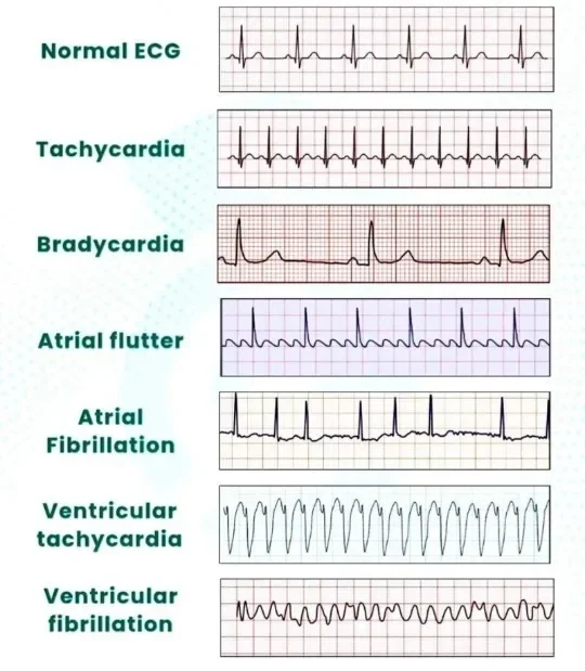 image about Cardiac Arrhythmia: Types, Symptoms, and Diagnostic Methods