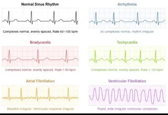 image about Cardiac Arrhythmia: Types, Symptoms, and Diagnostic Methods