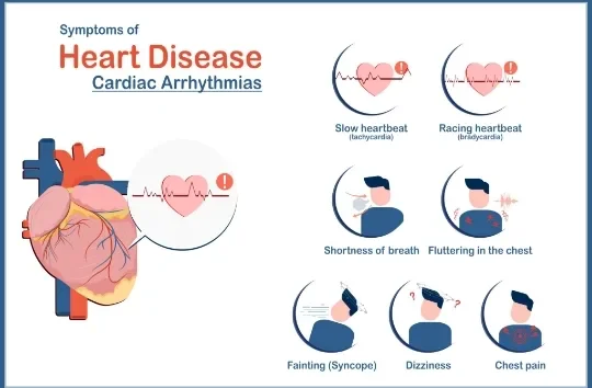 image about Cardiac Arrhythmia: Types, Symptoms, and Diagnostic Methods