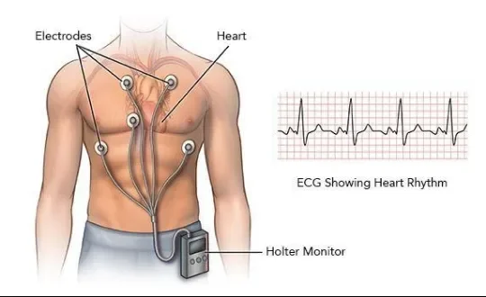 image about Cardiac Arrhythmia: Types, Symptoms, and Diagnostic Methods