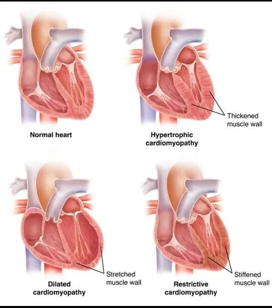 image about اعتلال عضلة القلب: الأنواع والأسباب وتأثيره على صحة القلب