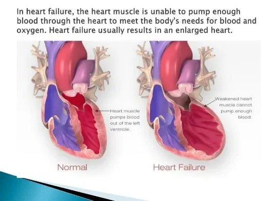 image about Heart Failure: Symptoms, Causes, Diagnosis, and Treatment