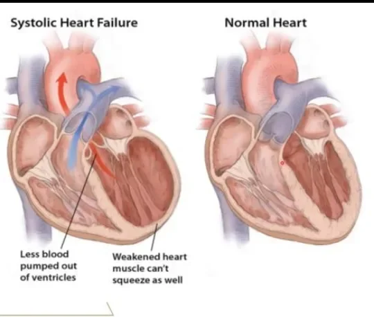 image about Heart Failure: Symptoms, Causes, Diagnosis, and Treatment