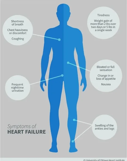image about Heart Failure: Symptoms, Causes, Diagnosis, and Treatment