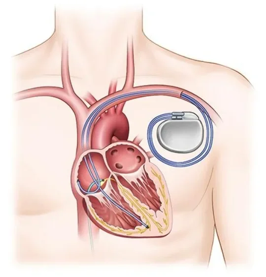image about Can Heart Deterioration Be Halted Before Reaching a Critical Stage? What Modern Treatments Say
