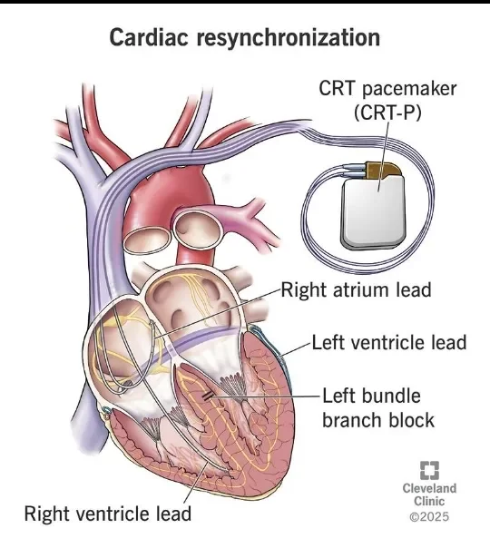 image about Can Heart Deterioration Be Halted Before Reaching a Critical Stage? What Modern Treatments Say