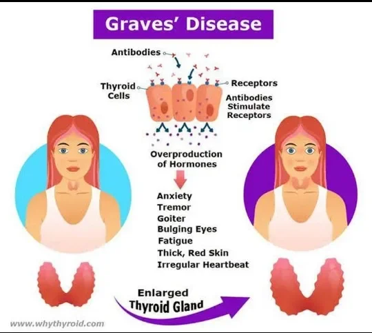 image about Thyroid Disorders, Weight Changes, and Pulse Irregularities: How Symptoms Overlap and Causes Differ