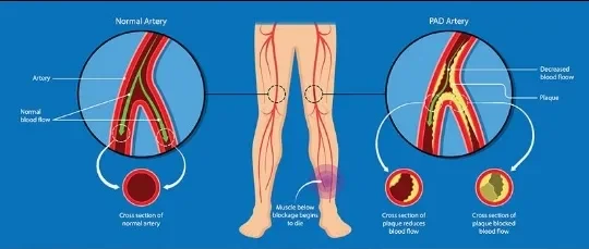 image about إشارة صغيرة في الساق قد تكشف خطرًا أكبر على القلب