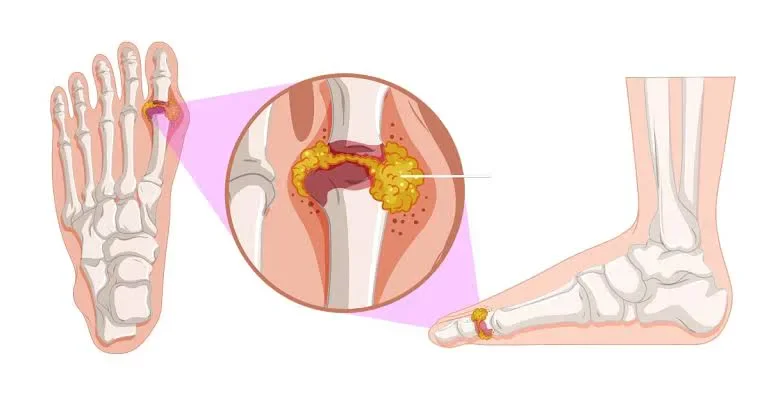 image about مرض النقرس  وكيفية العلاج والوقايه منه 