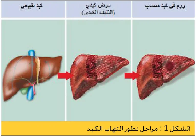 image about مرض التهابات الكبد الوبائي وكيفية الوقاية والعلاج 