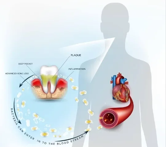 image about نزيف اللثة ليس أمرًا عابرًا.. ما العلاقة الخفية بين صحة الفم وأمراض القلب؟