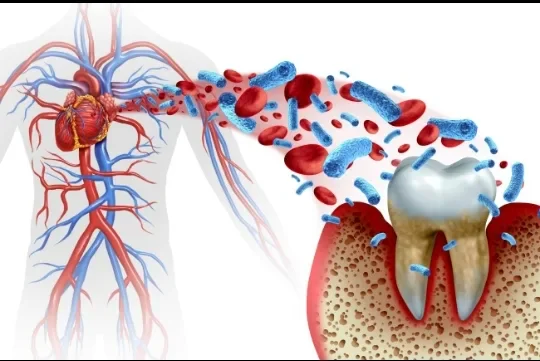 image about نزيف اللثة ليس أمرًا عابرًا.. ما العلاقة الخفية بين صحة الفم وأمراض القلب؟