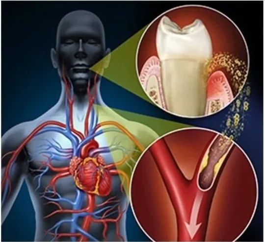 image about نزيف اللثة ليس أمرًا عابرًا.. ما العلاقة الخفية بين صحة الفم وأمراض القلب؟