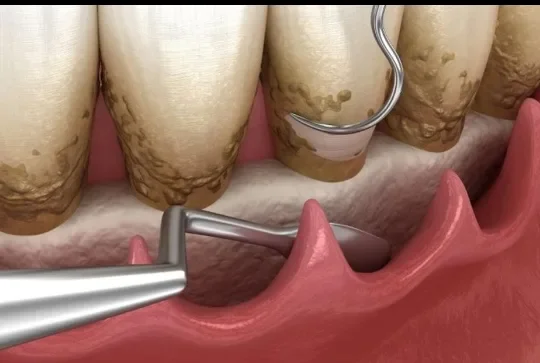 image about نزيف اللثة ليس أمرًا عابرًا.. ما العلاقة الخفية بين صحة الفم وأمراض القلب؟