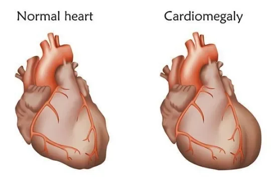 image about أهم الأسئلة حول تضخم عضلة القلب