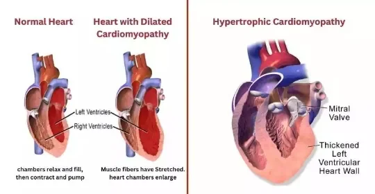 image about أهم الأسئلة حول تضخم عضلة القلب