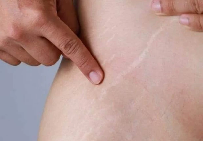 11 طريقة طبيعية وعلاجية للتخلص من الاسترتش ماركس.