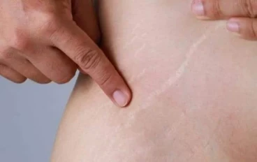 11 طريقة طبيعية وعلاجية للتخلص من الاسترتش ماركس.