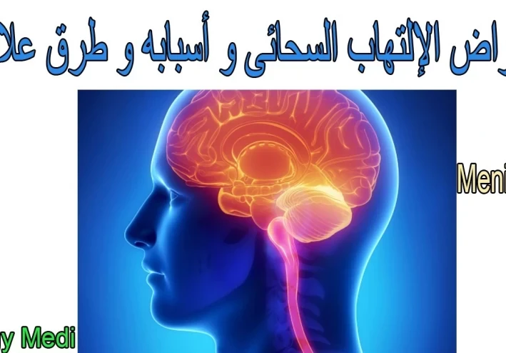 الالتهاب السحائى ( الحمى الشوكية )
