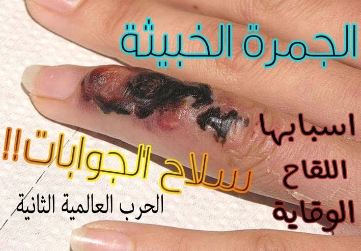 مرض الجمرة الخبيثة