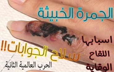 مرض الجمرة الخبيثة 
