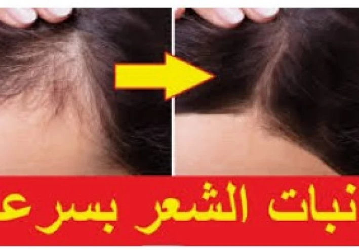 تكثيف وتطويل وتنعيم الشعر وعلاج فعال جدا جدا للثعلبه وعلاج فعال فى تساقط الشعر بكريم واحد فقط