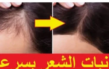 تكثيف وتطويل وتنعيم الشعر وعلاج فعال جدا جدا للثعلبه وعلاج فعال فى تساقط الشعر بكريم واحد فقط
