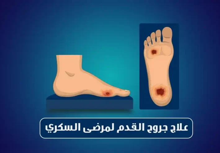 هل أنت مصاب بالسكر؟ 5 نصائح لأقدام صحية