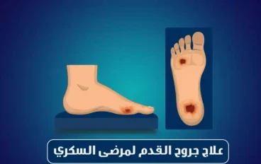 هل أنت مصاب بالسكر؟ 5 نصائح لأقدام صحية