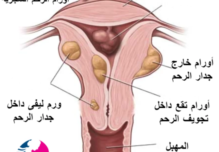 أعراض الأورام الليفية في الرحم وكيفية استئصالها