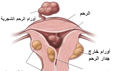 أعراض الأورام الليفية في الرحم وكيفية استئصالها