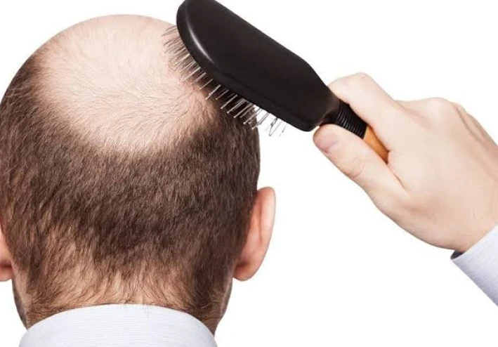 علاج تساقط الشعر للرجال وحل المشكله