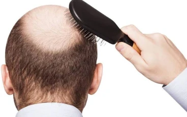 علاج تساقط الشعر للرجال وحل المشكله 