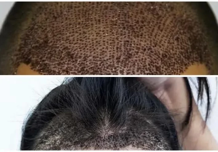 زراعة الشعر وكل ما تريد معرفته عنها