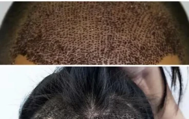 زراعة الشعر وكل ما تريد معرفته عنها