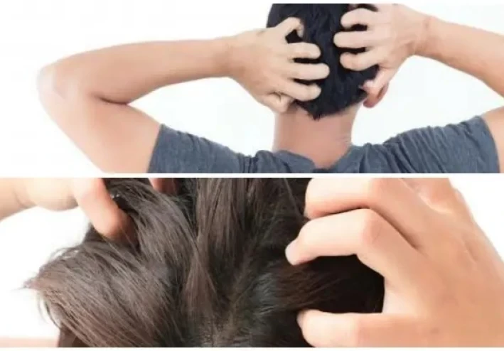 ما الذي يسبب حكة فروة الرأس؟ كيف تخفف حكة فروة الرأس؟
