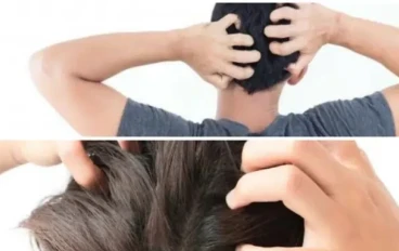 ما الذي يسبب حكة فروة الرأس؟ كيف تخفف حكة فروة الرأس؟